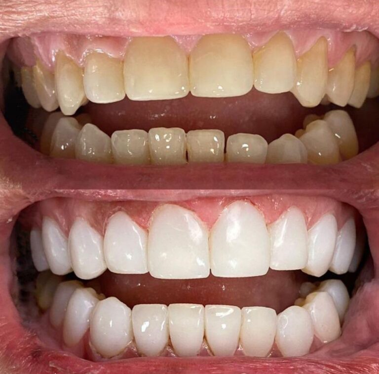 Cosmetic And Restorative Dentistry Miami - Before & After