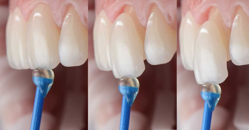 The Process of Getting Porcelain Veneers in Miami