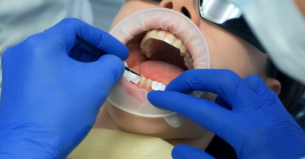 Are Veneers Painful to Get?