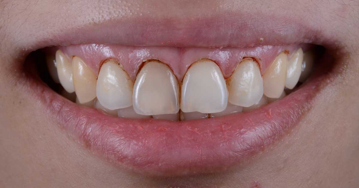 Is There a Downside to Veneers